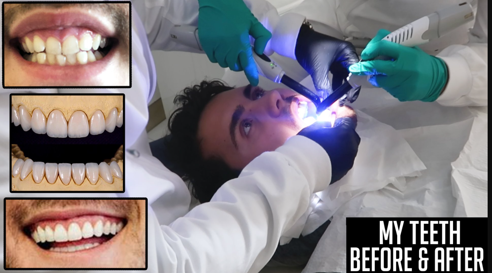 Alfie Deyes Teeth Before and After